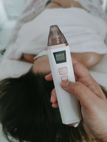 Customer photo review of Femvy Blackhead Remover 2.0