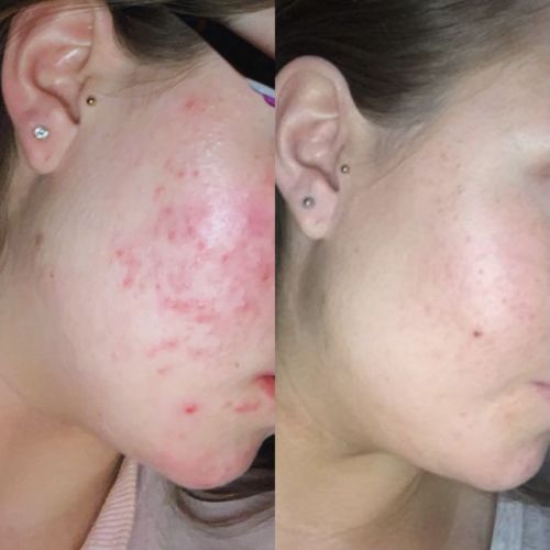 Customer photo review of Intermediate Reset Program