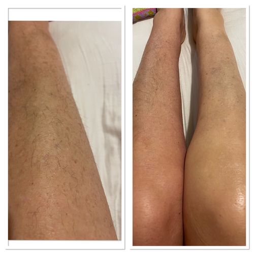 Customer photo review of Exfoliating Hair Removal Drop