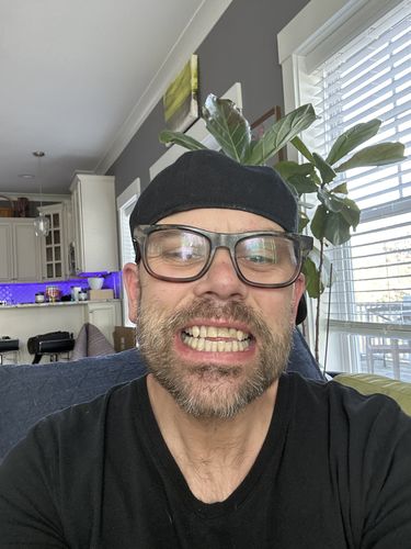 Customer photo review of Clear Retainer Partial Denture