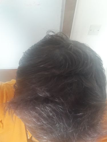 Customer photo review of Tugain 10% Minoxidil Extra Strength Topical Solution for Men.