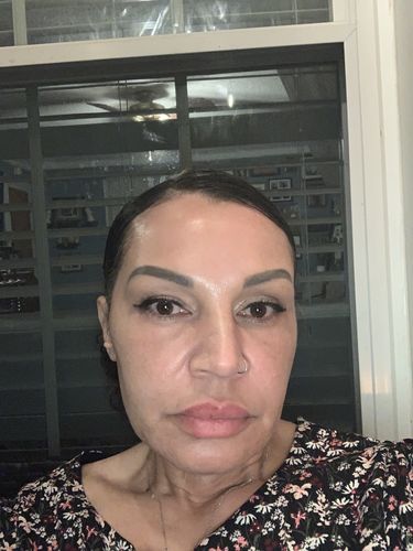 Customer photo review of WrinkleFix: Botox (Existing Customers)