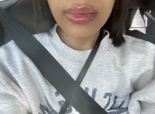 Customer photo review of LipFix: Filler