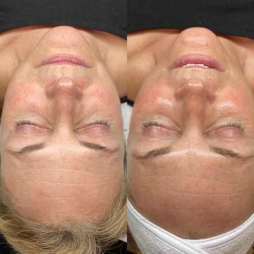 Customer photo review of KrX CO2 Carboxy Therapy