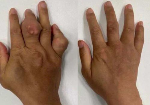 Customer photo review of CC™ Perfectx Joint And Bone Therapy Cream(Limited Time Discount 🔥 Last Day)