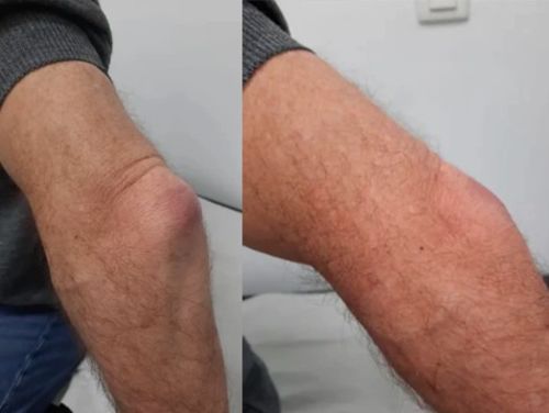 Customer photo review of CC™ Perfectx Joint And Bone Therapy Cream(Limited Time Discount 🔥 Last Day)