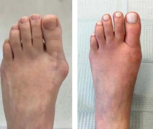 Customer photo review of CC™ Perfectx Joint And Bone Therapy Cream(Limited Time Discount 🔥 Last Day)