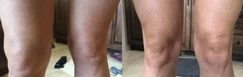 Customer photo review of CC™ Perfectx Joint And Bone Therapy Cream(Limited Time Discount 🔥 Last Day)