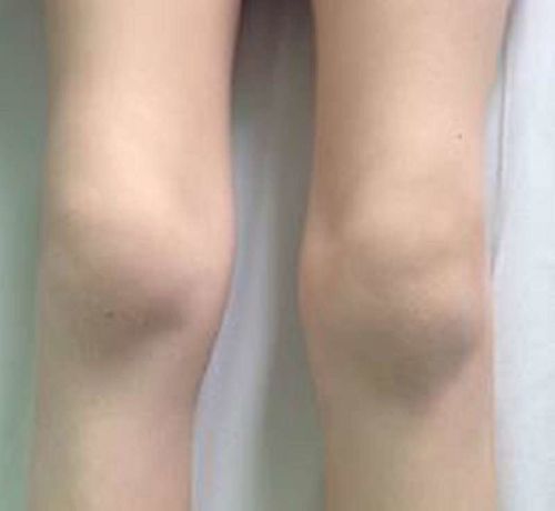 Customer photo review of CC™ Perfectx Joint And Bone Therapy Cream(Limited Time Discount 🔥 Last Day)