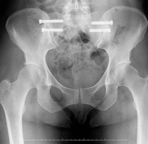 Customer photo review of CC™ Perfectx Joint And Bone Therapy Cream(Limited Time Discount 🔥 Last Day)