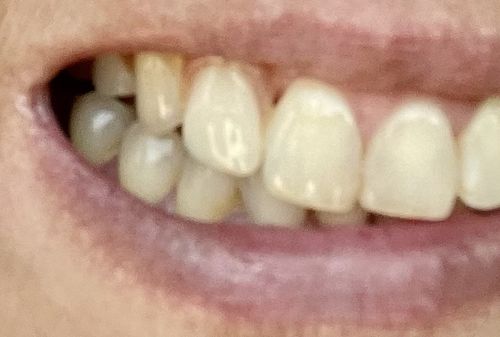 Customer photo review of Flexible Partial Denture