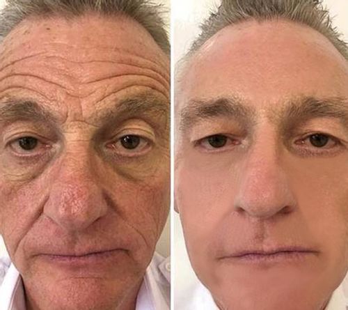 Customer photo review of Pedia™ Advanced Collagen Boost Anti Aging Serum ( Limited time discount Last 30 minutes)