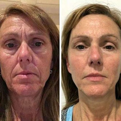 Customer photo review of Pedia™ Advanced Collagen Boost Anti Aging Serum ( Limited time discount Last 30 minutes)