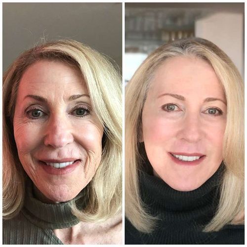 Customer photo review of Pedia™ Advanced Collagen Boost Anti Aging Serum ( Limited time discount Last 30 minutes)