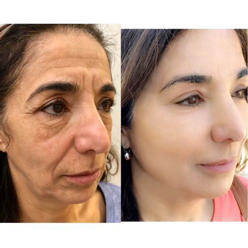 Customer photo review of Pedia™ Advanced Collagen Boost Anti Aging Serum ( Limited time discount Last 30 minutes)