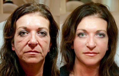 Customer photo review of Pedia™ Advanced Collagen Boost Anti Aging Serum ( Limited time discount Last 30 minutes)