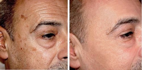 Customer photo review of Pedia™ Advanced Collagen Boost Anti Aging Serum ( Limited time discount Last 30 minutes)