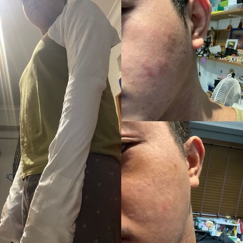 Customer photo review of Eczema Scratch Mitten