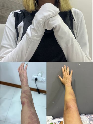 Customer photo review of Eczema Scratch Mitten