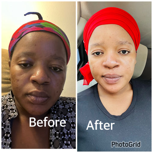 Customer photo review of Intense Discoloration Treatment (Rapid Action)