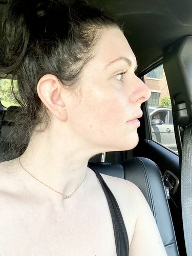 Customer photo review of JawlineFix: Filler