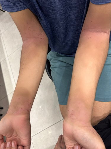 Customer photo review of Eczema Scratch Mitten