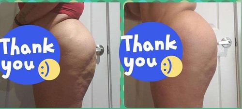 Customer photo review of *SPECIAL* 2Month Supply Booty Enhancement