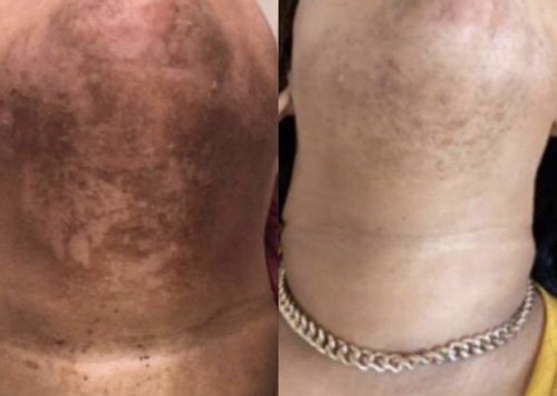 Customer photo review of 24k Golden Glow Essential Acne Kit