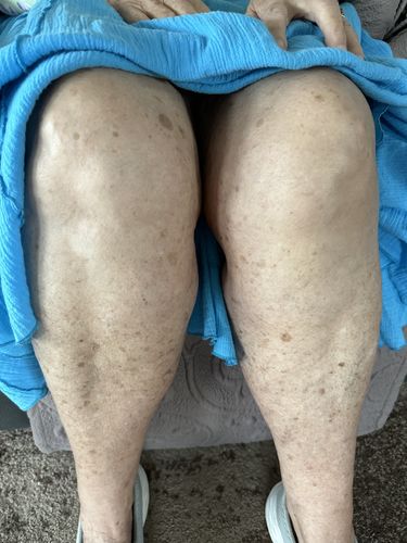 Customer photo review of CC™ Perfectx Joint And Bone Therapy Cream(Limited Time Discount 🔥 Last Day)