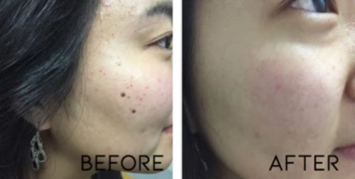 Customer photo review of CC™ Tags & Moles Remover