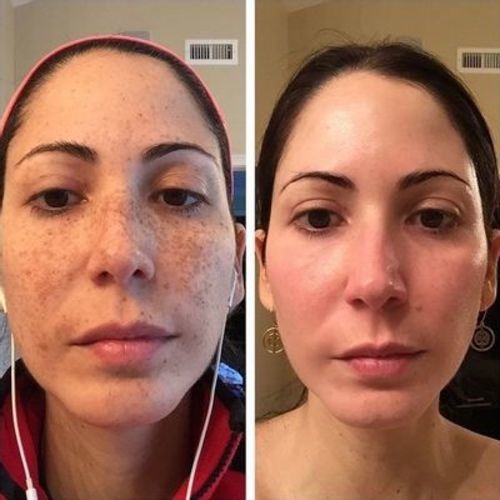 Customer photo review of CC™ Tags & Moles Remover