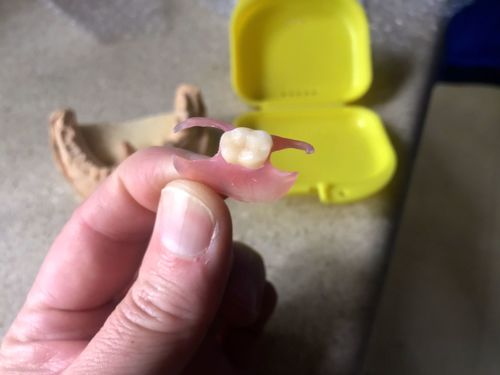 Customer photo review of Flexible Partial Denture