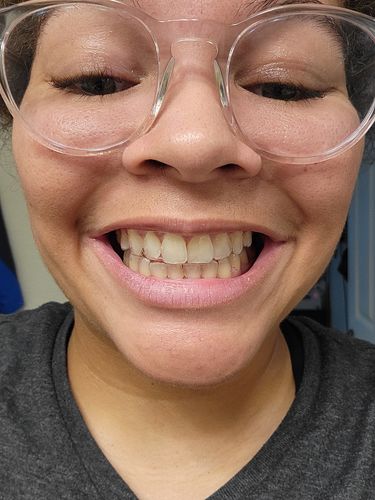 Customer photo review of Upper and Lower Retainers Set