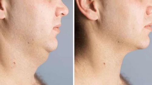 Customer photo review of Lymph Flow Magnetogen Earrings(🔥LAST DAY SALE-80% OFF)