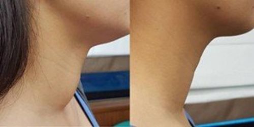 Customer photo review of (🔥LAST DAY SALE-80% OFF) Lovefinity™ Lymphvity MagneTherapy Germanium Earrings