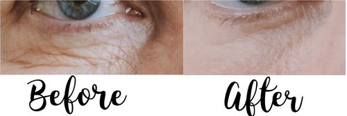 Customer photo review of EvenSkyn® Lumo: Premium Anti-Aging & Skin Tightening Handset