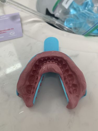 Customer photo review of Upper and Lower Retainers Set