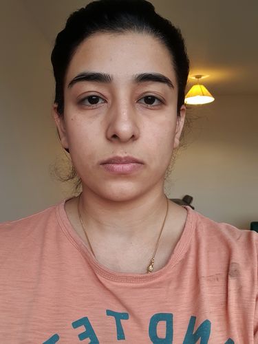 Customer photo review of EvenSkyn® Lumo: Premium Anti-Aging & Skin Tightening Handset