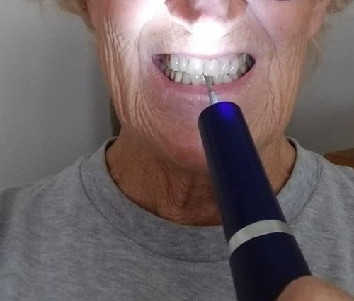 Customer photo review of Liroxa™ Ultrasonic Scaler Dental Pro