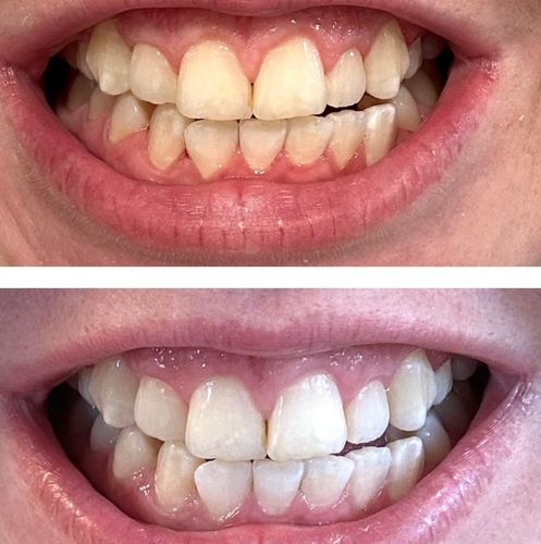 Customer photo review of Liroxa™ Teeth Whitening Pen Kit