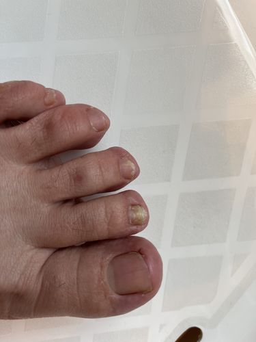 Customer photo review of Kerassentials Nail Serum