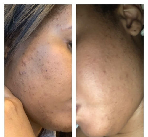 Customer photo review of LIMITED EDITION KIT Jolie’s Mini Full Body & Face Brightening Kit
