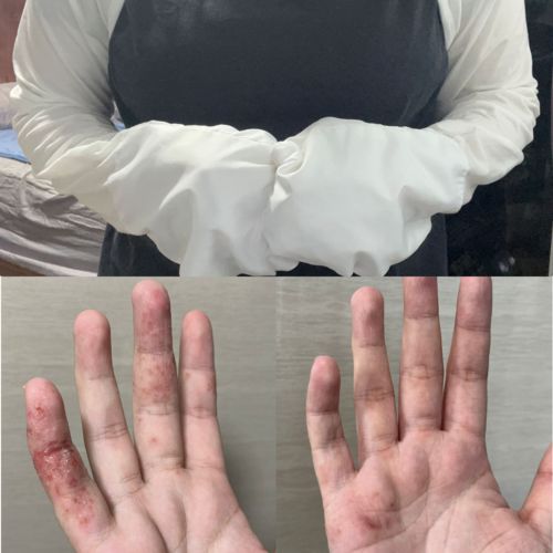 Customer photo review of Eczema Scratch Mitten