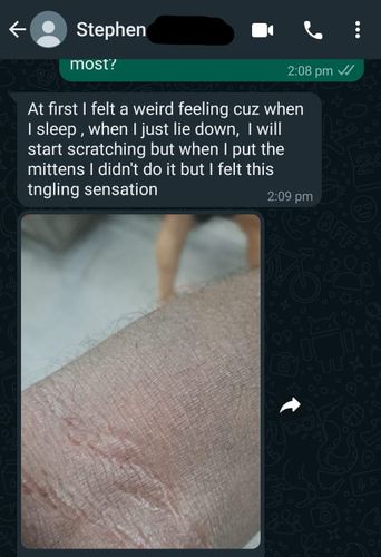 Customer photo review of Eczema Scratch Mitten