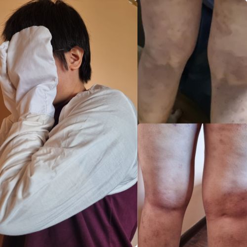 Customer photo review of Eczema Scratch Mitten