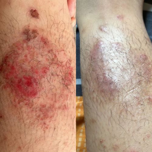 Customer photo review of Eczema Scratch Mitten