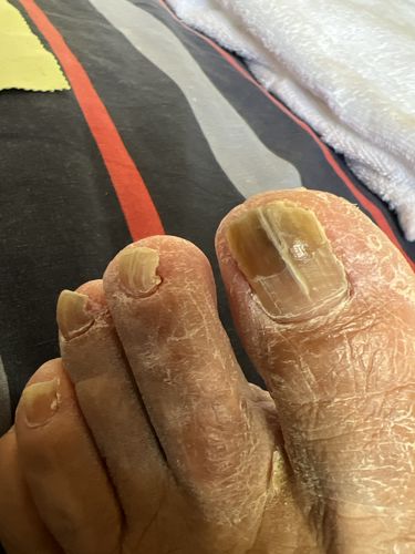 Customer photo review of 3 X Stronger Fungus Defend Max 40 Billion CFU