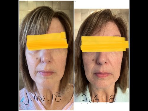 Customer photo review of EvenSkyn® Lumo⁺: Premium Anti-Aging & Skin Tightening Handset (Pre-Order)