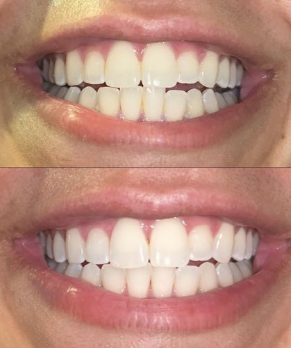 Customer photo review of Liroxa™ LED Teeth Whitening Accelerator