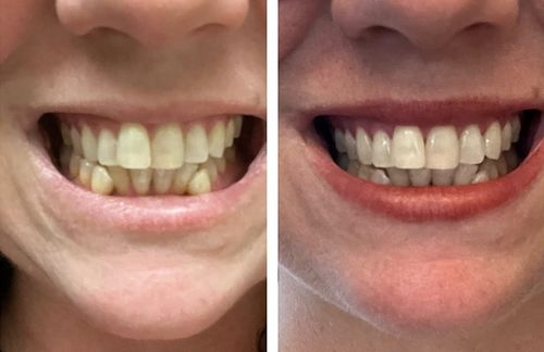 Customer photo review of Liroxa™ LED Teeth Whitening Accelerator